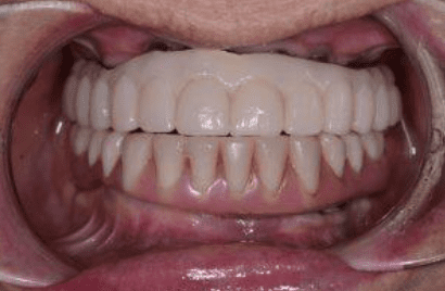 A Challenging Hybrid Overdenture Case A Challenging Hybrid Overdenture Case